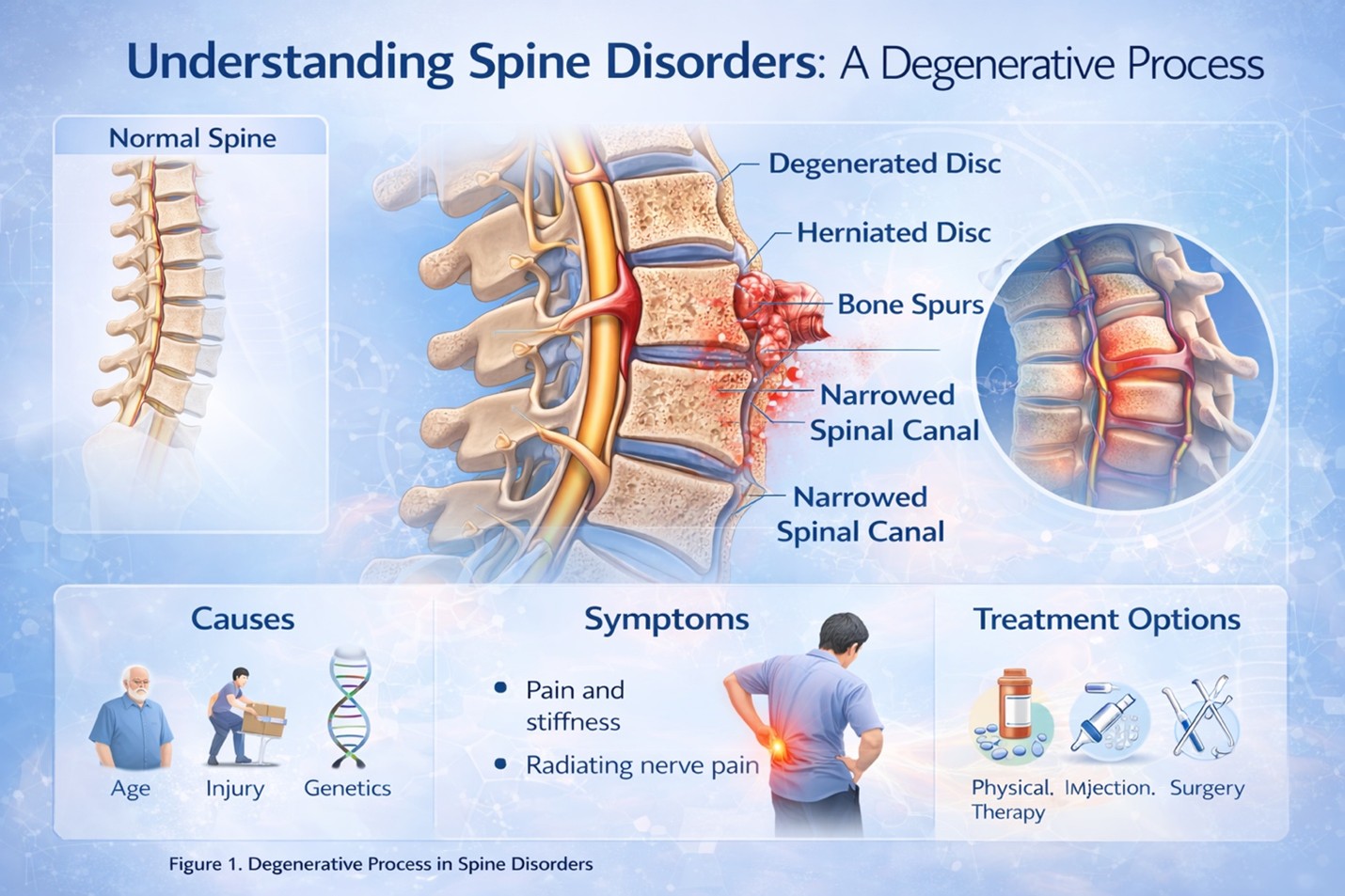 Figure 1: Degenerative Changes in Spine Disorders