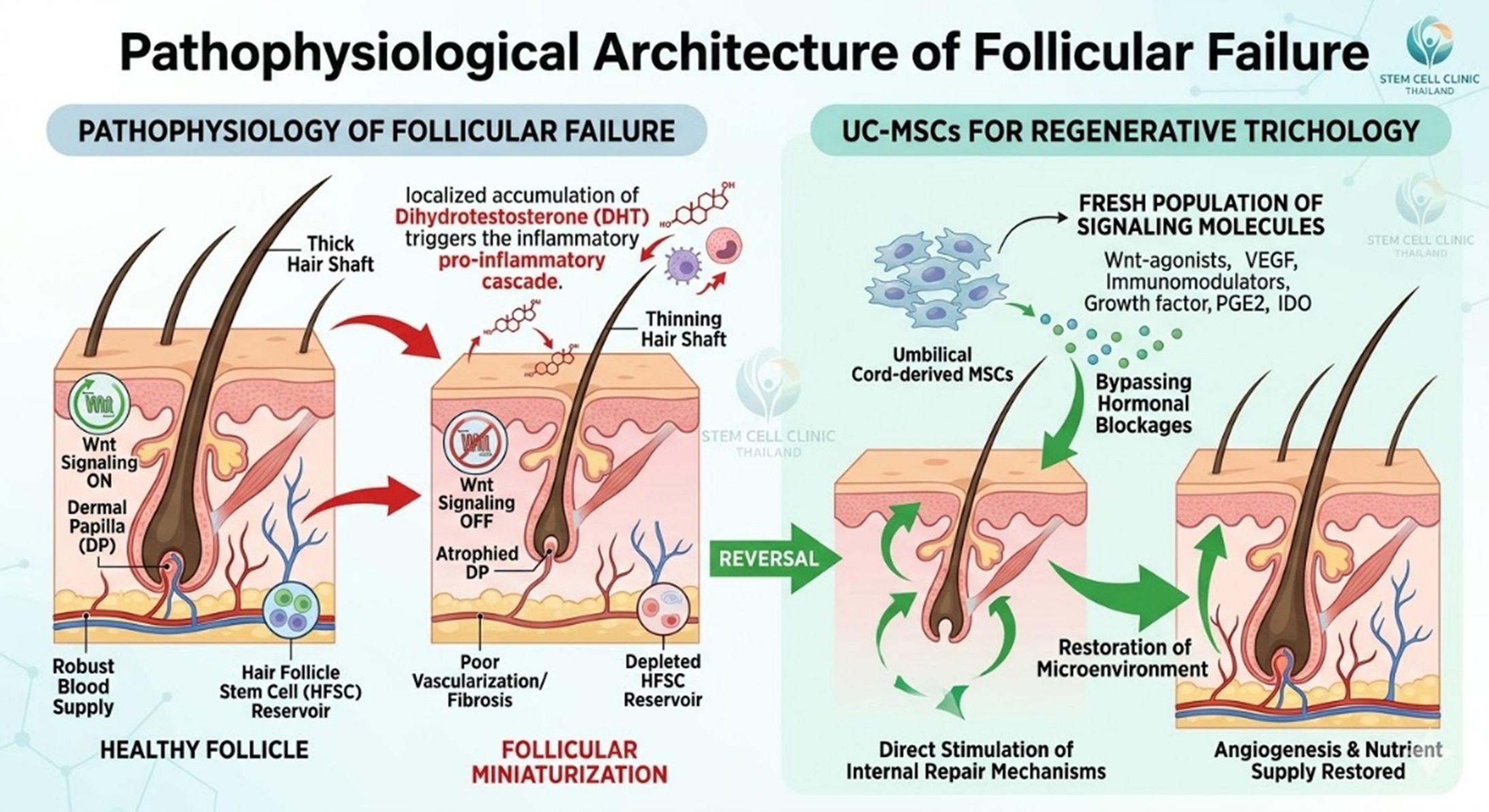 Figure 1: Pathophysiological Architecture of Follicular Failure and Strategic Potency of UC-MSCs in Regenerative Trichology