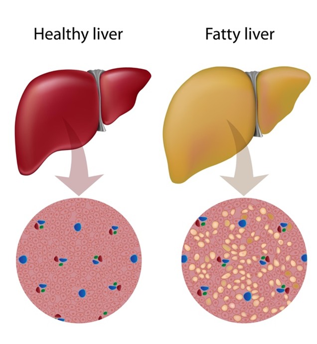 Figure B: The Liver: De-Gunking the Metabolic Hub