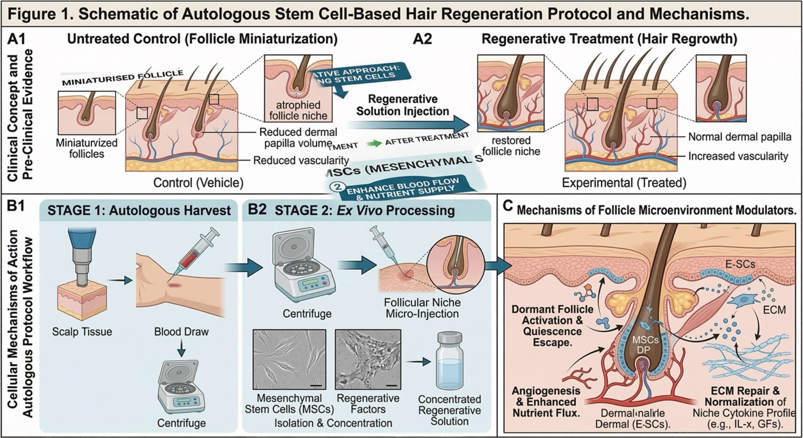 Figure 1: Schematic of Autologous Stem Cell Hair Therapy. (A) Comparison of follicle miniaturization versus regrowth after treatment. (B) Clinical workflow involving tissue/blood harvest, centrifugation, and scalp micro-injection. (C) Biological mechanisms showing follicle activation, increased blood flow (angiogenesis), and repair of the scalp microenvironment.