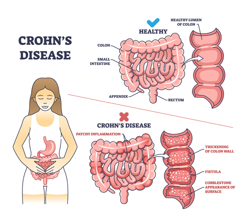 Figure A: Crohn’s disease causes patchy inflammation in the digestive tract, which can lead to wall thickening, ulcers, and complications like fistulas