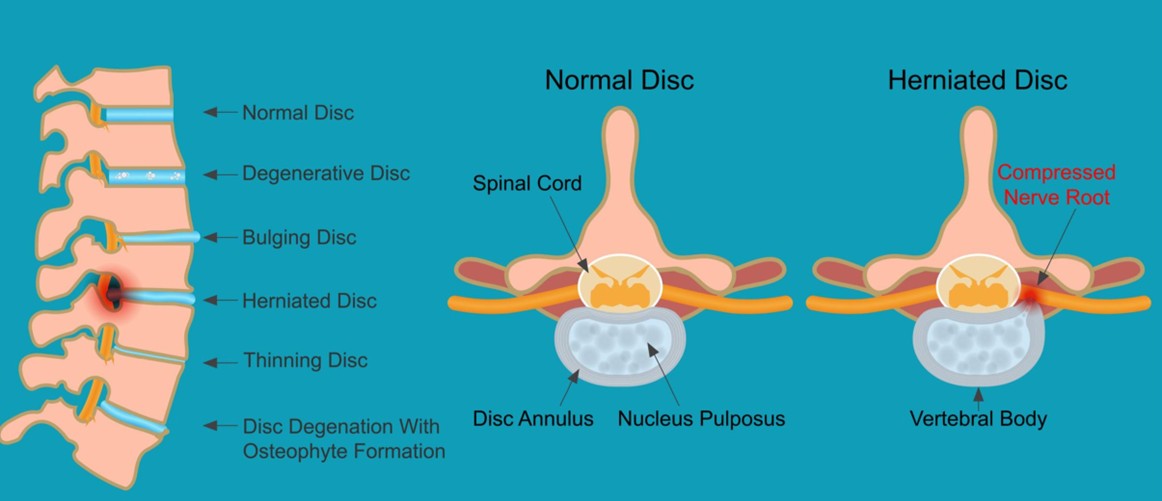 Figure 1: Biological Mechanisms in IDP : Schematic illustration of intervertebral disc degeneration, including loss of hydration, extracellular matrix breakdown, inflammation, and nerve compression. These processes contribute to pain, reduced mobility, and structural changes in the spine.