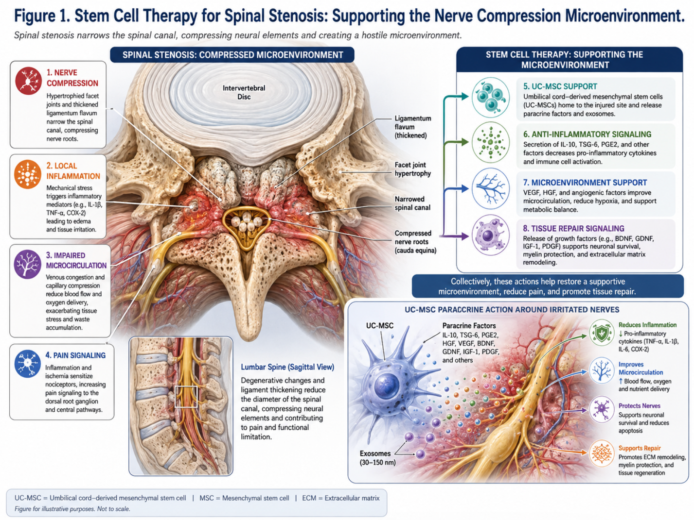 Figure 1: Stem Cell Therapy for Spinal Stenosis: Supporting the Nerve Compression Microenvironment