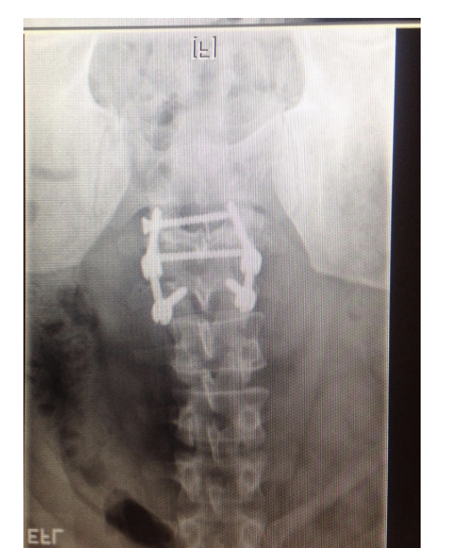 Figure 1: Lumbar flexion and extension radiographs